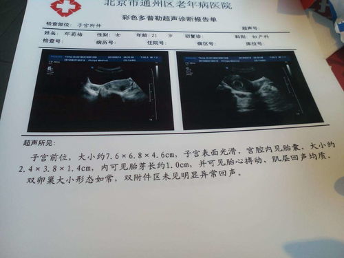 打胎多久可以看妇科门诊 打胎多久可以看妇科门诊