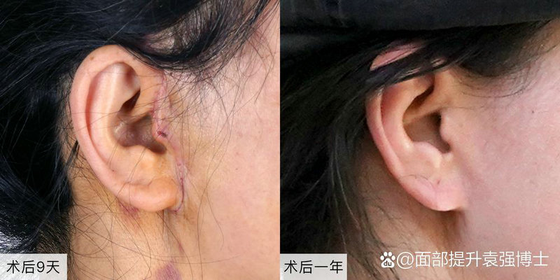 打胎后在家可以种树 打胎后可以养猫吗 打胎后在家可以种树 打胎后可以养猫吗