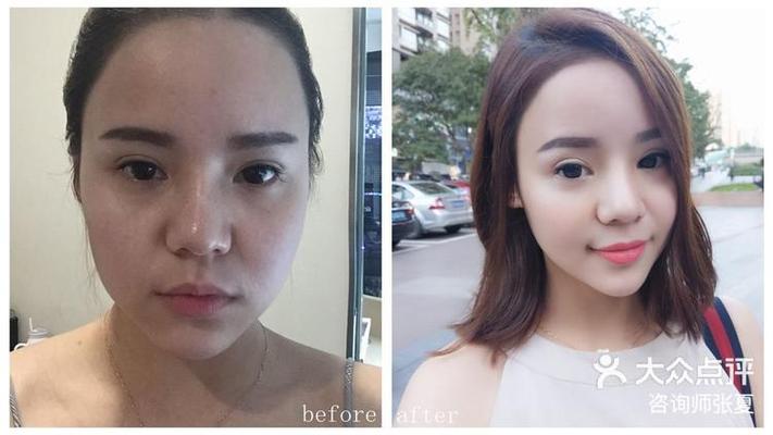 三个月打胎可以不引产吗 三个月打胎可以不引产吗