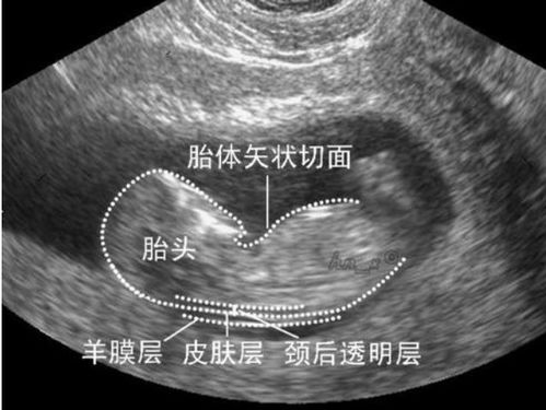 建档了怎么打胎 怀孕建档了还能打胎吗